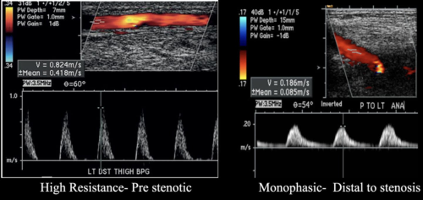 <p>Drag PW cursor through entire stenotic area</p><p>Record pre-stenotic, stenotic, post-stenotic, and distal to stenosis zones</p>