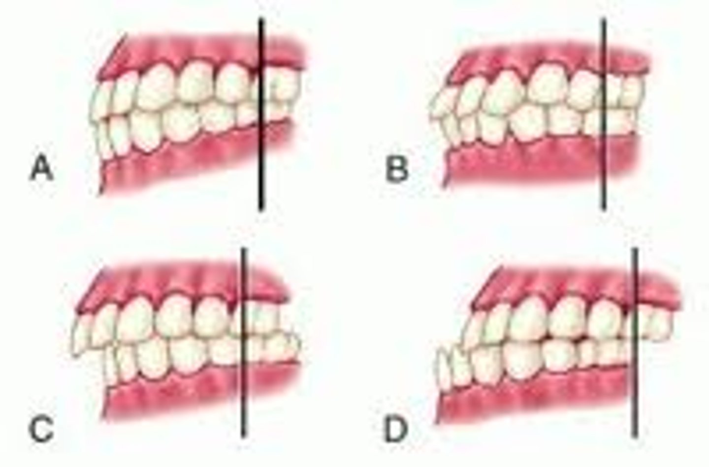 <p>abnormal relationship of the teeth when biting or closing.</p>