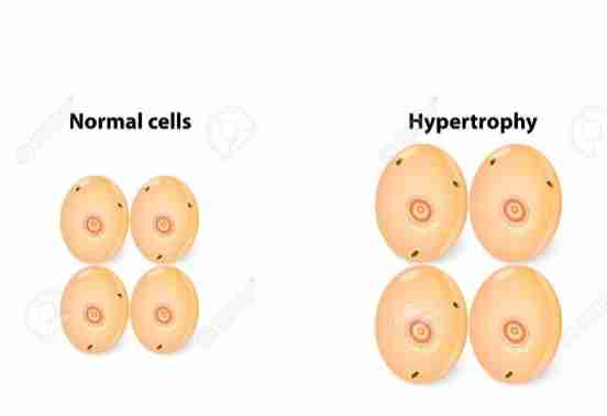 <p>Bigger cells</p><ul><li><p>Increase in size of organ/tissue due to increase in size of cell</p></li></ul><ol><li><p>Physiologic</p></li></ol><ul><li><p>Hypertrophy of skeletal muscle in muscle builder </p></li></ul><ol start="2"><li><p>Pathologic </p></li></ol><ul><li><p>Hypertrophy of cardiac heart in hypertension </p></li></ul><p>Mechanism :</p><ul><li><p>Increase in protein synthesis &amp; increase in size/number of intracellular organelles </p></li><li><p>End result: larger organ</p></li><li><p>Increase in functional capacity </p></li><li><p>May occur with hyperplasia </p></li></ul>