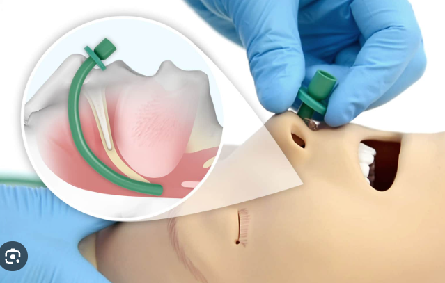 <p>-Een nasofaryngeale canule, deze zorgt ervoor dat de doorgang tussen een neusgat en de farynx open blijft.</p><p>De lengte is de afstand van de neustip tot de tragus van het oor. De diameter is ongeveer die van de pink van het kind.</p><p>-Larynxmasker, het is geen eerste keuze omdat het plaatsen niet makkelijk is en er risico is op dislocatie, het niet geschikt is voor langdurig gebruik en het geen bescherming bied tegen aspiratie.</p><p>-Intuberen, om aspiratie te voorkomen moet er een cuff aanwezig zijn. Het kan zowel nasotracheaal als orotracheaal, nasotracheale intubatie heeft bij kinderen de voorkeur. Dit omdat het kind de tube niet kan dichtbijten en omdat eenvoudige mondhygiëne mogelijk is. Het nadeel is dat het veel expertise vraagt om te plaatsen en dat er risico is op decubitus van de neus. Je mag het niet doen bij verhoogde bloedingsneigingen en bij anatomische afwijkingen.</p>