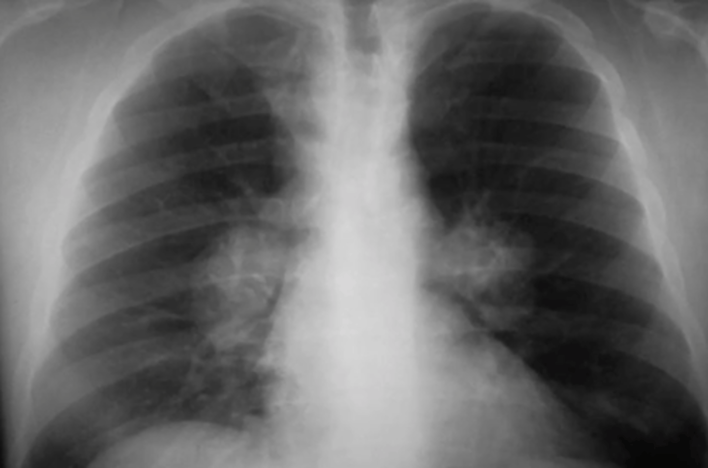 <p>(evaluating AP CXR) masses on hilar region (bilateral hilar LAD)</p>
