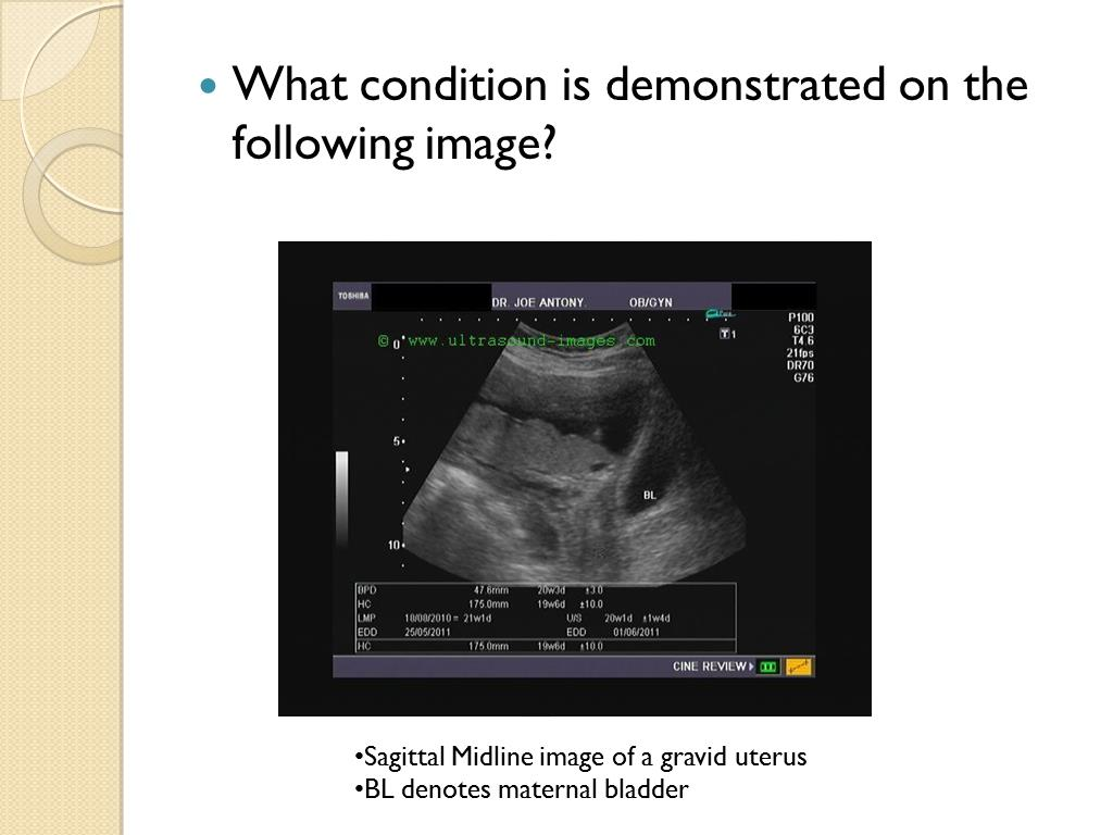 <p>What condition of the placenta is seen?</p>