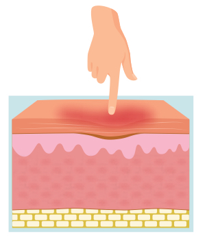 <p>what is a stage 1 pressure injury?</p>