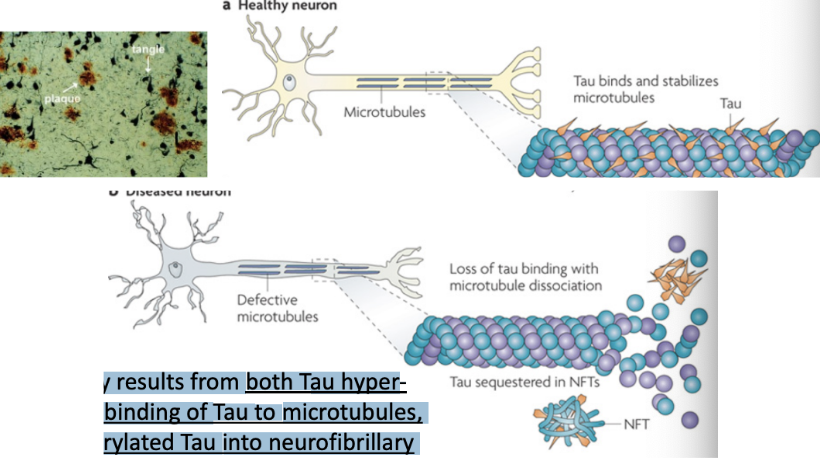 \
* Tau aggregation in an insoluble form may be involved in Alzheimer’s disease pathogenesis
  * Tau is particularly abundant in neurons and facilitates microtubule stabilization and is normally phosphorylated. Tau function is compromised in Alzheimer's disease and other Tauopathies. This probably results from both Tau hyperphosphorylation, which reduces the binding of Tau to microtubules, and sequestration of hyper-phosphorylated Tau into neurofibrillary tangles (NFTs), which reduces the amount of Tau available to bind microtubules. Loss of Tau function leads to microtubule instability and reduced axonal transport, which could contribute to neuropathology.
  * Tangles are aggregates of Tau when they fall off of microtubules