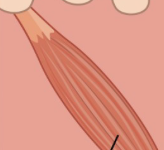 <p>small band of smooth muscle attached to the follicle</p>