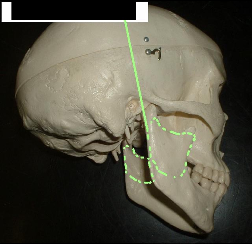 <p>The part that runs up and down the sides of the Mandible.</p>