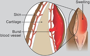 <p>Subcutaneous, subperichondral, or intrachondral locations</p>