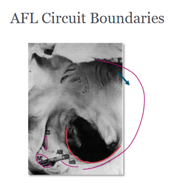 <p>Anterior: tricuspid annulus (electrically inert fibrous tissue)</p><p>Posterior: crista terminalis at floor of the RA merging with Eustachian ridge/IVC, CS Ostium</p>