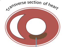 <p>A NSTEMI indicates _______ _________ damage of the heart muscle. Electrical impulses show through the healthy sliver of tissue.</p>