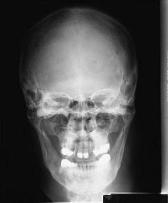 <p><strong>Which baseline is perpendicular to the IR in the image below?</strong><br>A. Glabellomeatal line<br>B. Infraorbitomeatal line<br>C. Orbitomeatal line<br>D. Acanthiomeatal line</p>