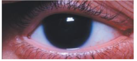 <p>congenital abnormality charactered by no colored iris—all black</p>