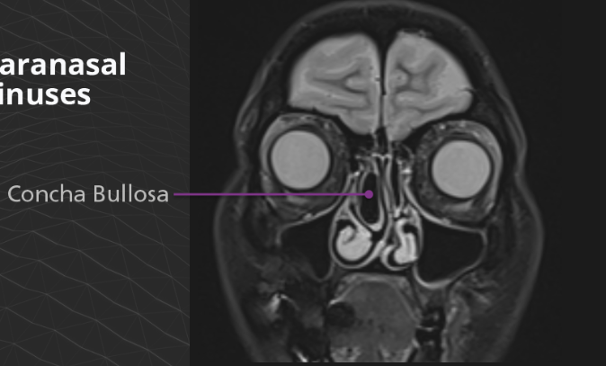 <p>Concha bullosa is an air cell within the middle turbinate and is often associated with chronic sinusitis or nasal obstruction. </p>