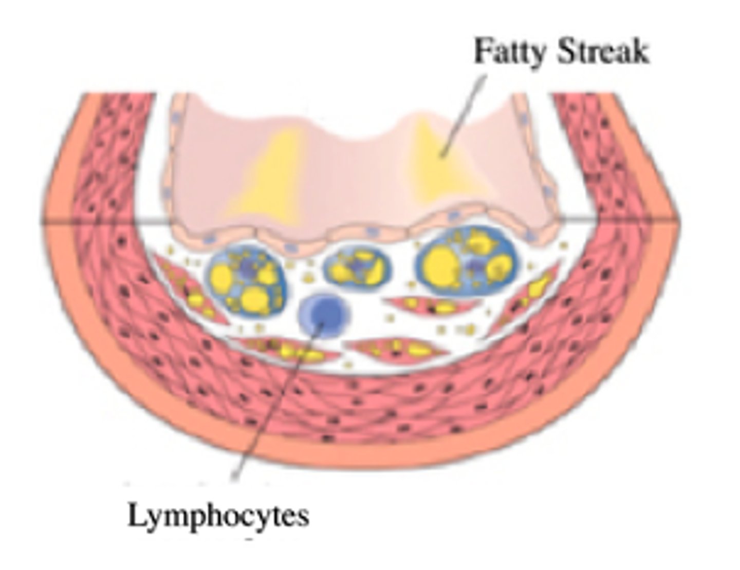 <p>fatty streak</p>