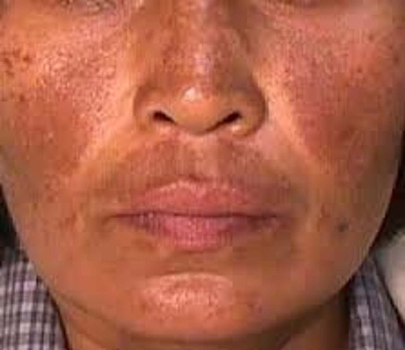 <p>- AKA Melasma</p>