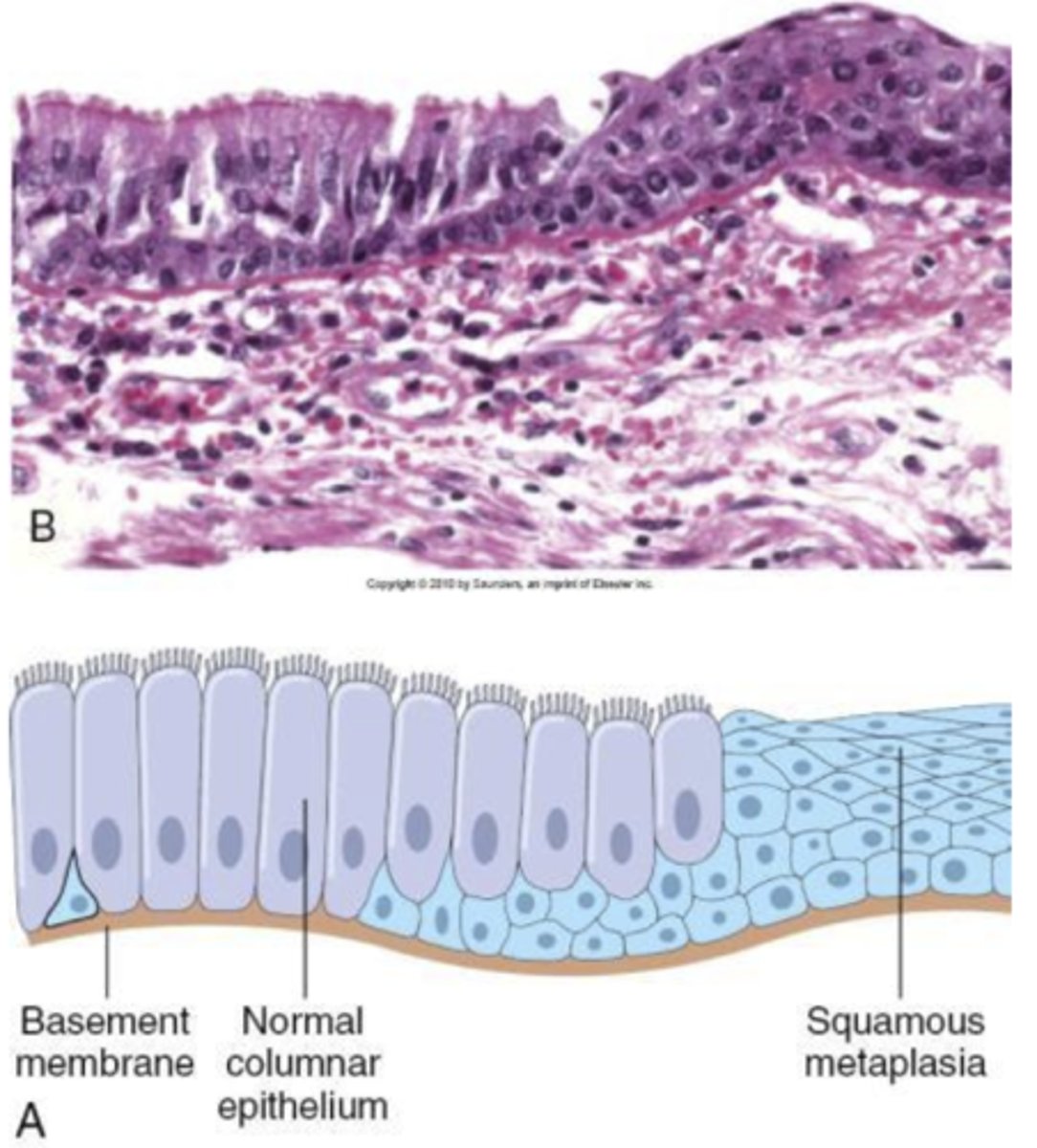 <p>replacement of one differentiated cell type with another mature differentiated cell type that is not normally present in that tissue. this is different from one cell type converting into another. it is generally adaptive, benign and reversible.</p><p>persistent metaplasia can be a precursor to dysplasia which can progress to carcinoma.</p>