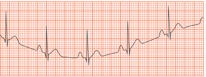 <p>A medical assistant obtains the tracing shown above on a patient.  Which of the following actions should the medical assistant take?</p><p></p><p>A. Remind the patient to remain as still as possible.</p><p>B. Ensure precordial lead wires are crossed to balance polarization.</p><p>C. Check for incorrect lead placement.</p><p>D. Place the patient in Trendelenburg’s position.</p>