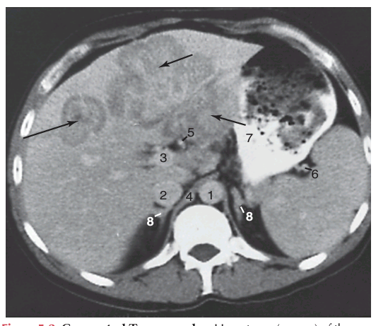 <p>It uses a computerized x-ray system to produce detailed sectional x-ray images (Figure 5-2). The system is very sensitive to differences in tissue density and produces detailed two-dimensional planar images; the use of contrast agents increases attenuation. In spiral or helical CT scanning pictures are taken continuously, which decreases the time needed to obtain images.</p>
