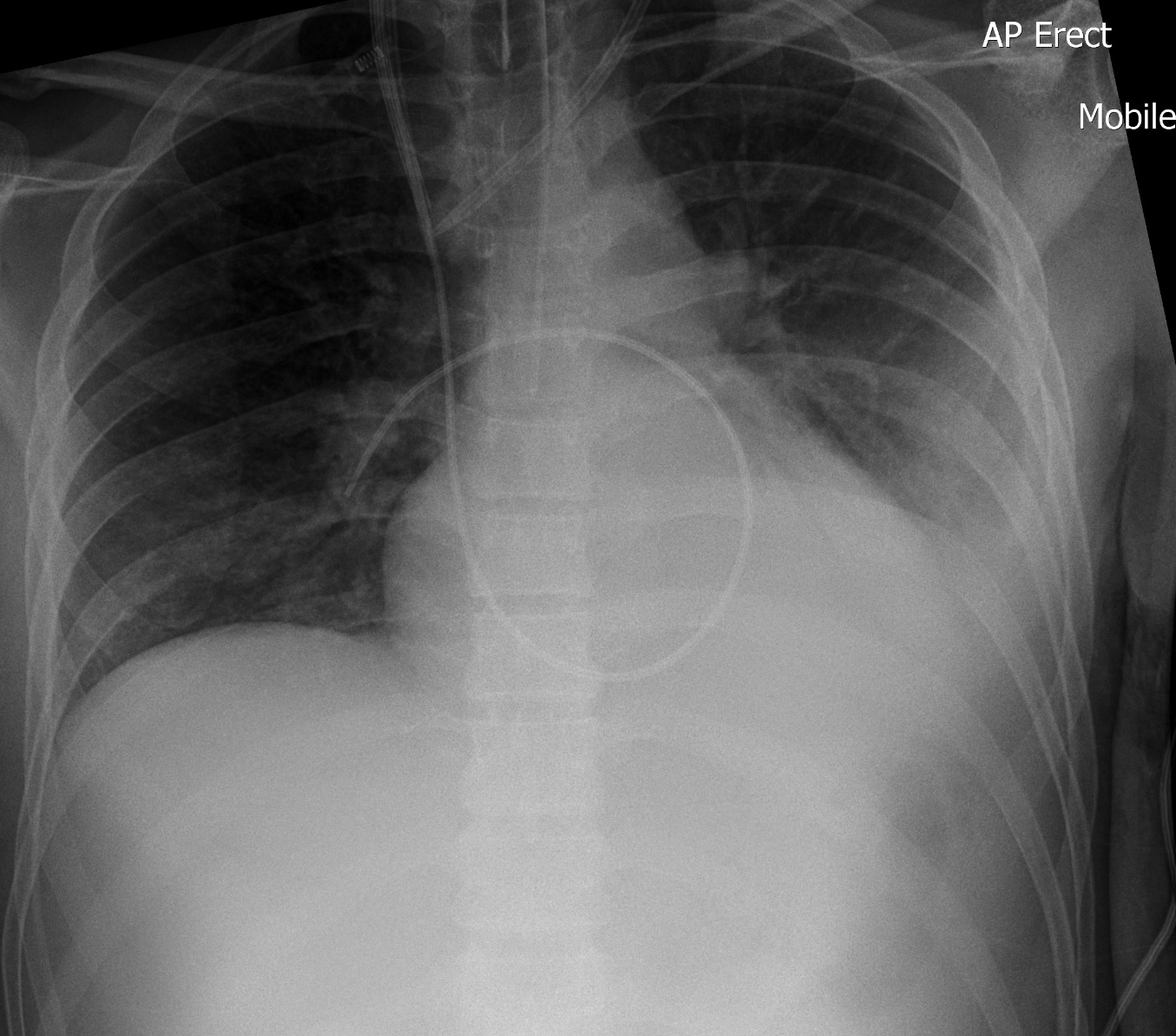 <p>Make a U-turn in the heart shadow, with the tip in the pulmonary trunk, just below the carina.</p>