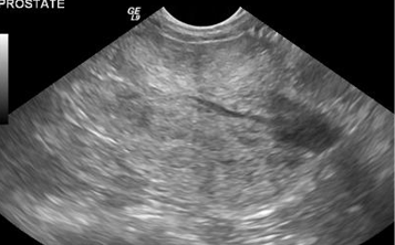 <p>Hyperechoic</p><p>Heterogenous</p><p>Radiating pattern</p><p>Often associated with cysts but not always</p>
