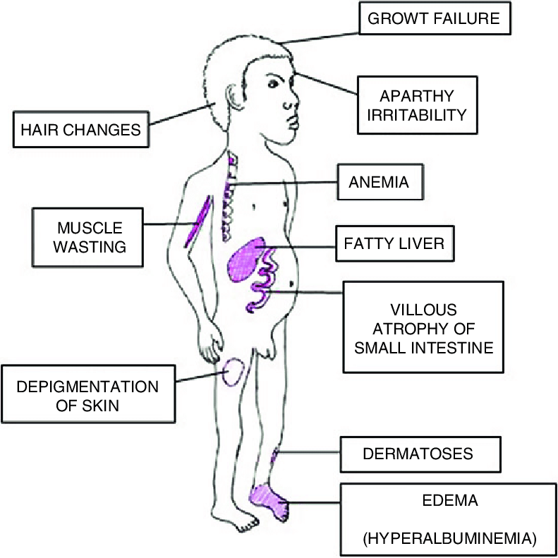 <p>Akut malnutrition med <strong>protein- och energibrist</strong>. Vikten kan vara både låg och normal för åldern. Det uppstår anasarka → ett generaliserat ödem/svullnad som beror på proteinbrist. Det ger leversteatos, apati, tarmsvullnad och hypotermi. </p>