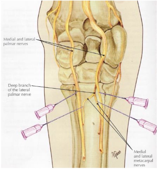 <p>what is desensitized in a high 4 point nerve block (below carpus)</p>