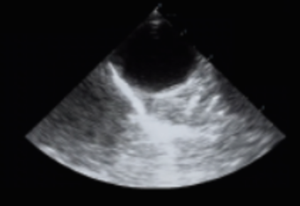 <p>TEE Midesophageal descending thoracic aorta SAX taken at 0 degrees</p>