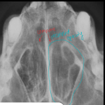 <p>Non-destructive rhinitis</p>