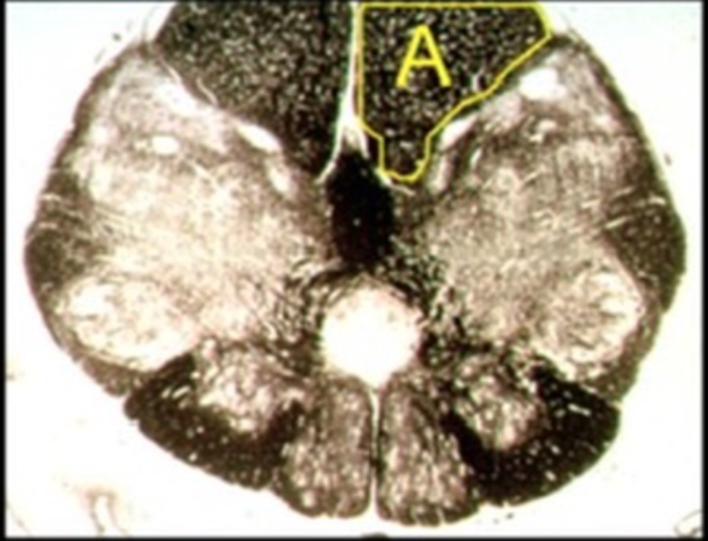 <p>Describe the signs/symptoms you will see if structure "A" is lesioned.</p>