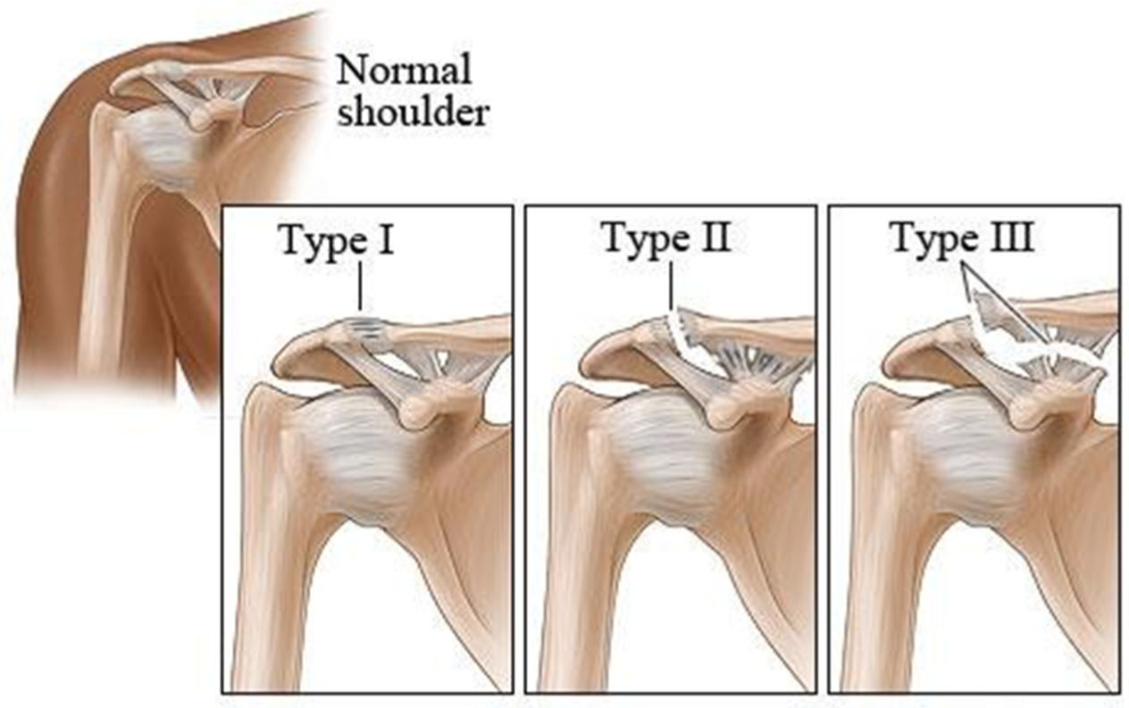 <p>Diagnose this injury. Provide Moi, signs and symptomsand management</p>