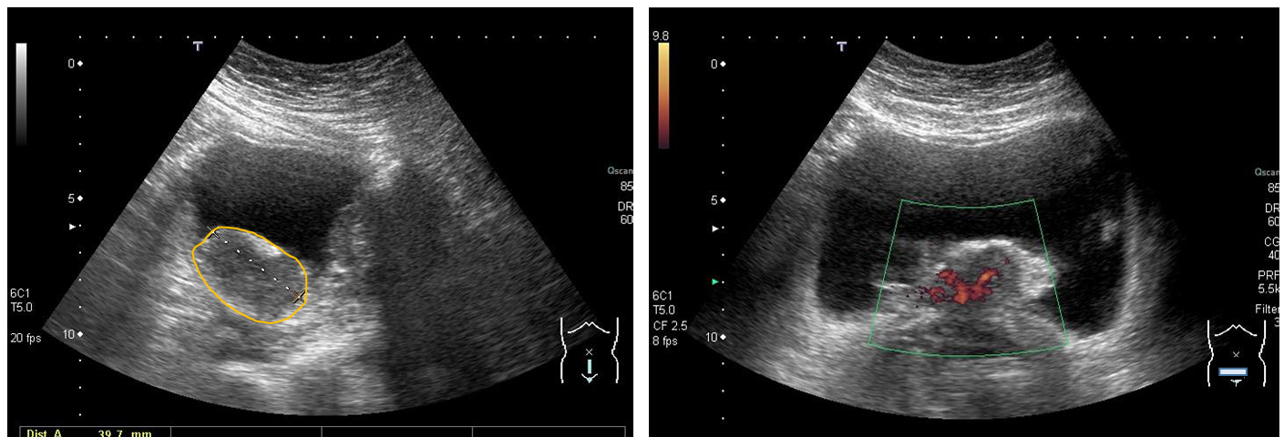 <p>Patient history:elderly patient with macroscopic hematuria </p><p> Modality: Ultrasonography of the urinary bladder with convex probe (3.5–5 MHz), B mode (left image) and Power Doppler mode (right image) Region: pelvis, sagittal and transverse views </p><p>Radiological sign: Lobulated, hypoechoic, vascularized (Doppler-sign detectable) solid mass, which protrudes into the lumen of the urinary bladder. The bladder contains anechoic urine. </p><p>Diagnosis:urinary bladder transitional cell carcinoma</p>