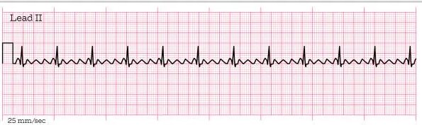 <p>id this EKG</p>