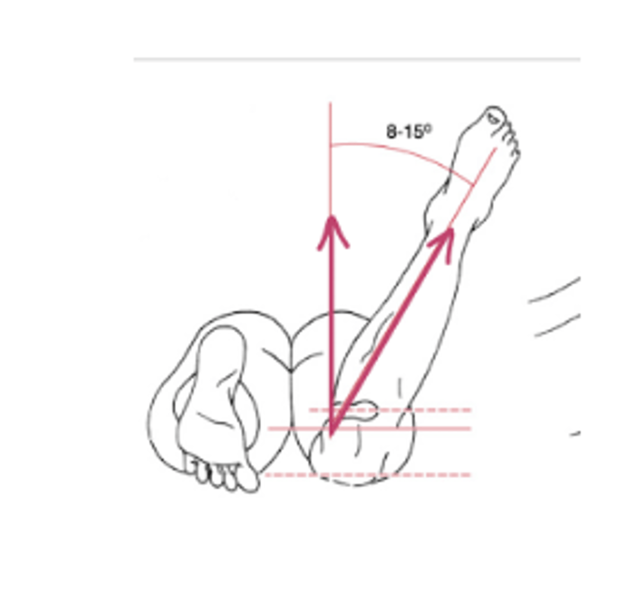<p>Normal males: 8-12 degrees</p><p>Normal females: 12-18</p><p>Put hand on greater trochanter and IR/ER femur</p><p>Tests for femoral anteversion → if lots of IR you have anteversion</p>