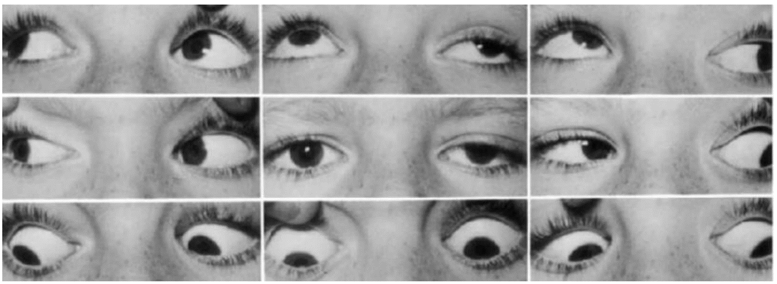 <p>Physical examination from a 22-year-old female with diplopia reveals the results shown in the accompanying image. What nerve is injured?</p><p>A. Left CN II</p><p>B. Left CN III</p><p>C. Left CN IV</p><p>D. Left CN VI</p><p>E. Right CN II</p><p>F. Right CN III</p><p>G. Right CN IV</p><p>H. Right CN VI</p>