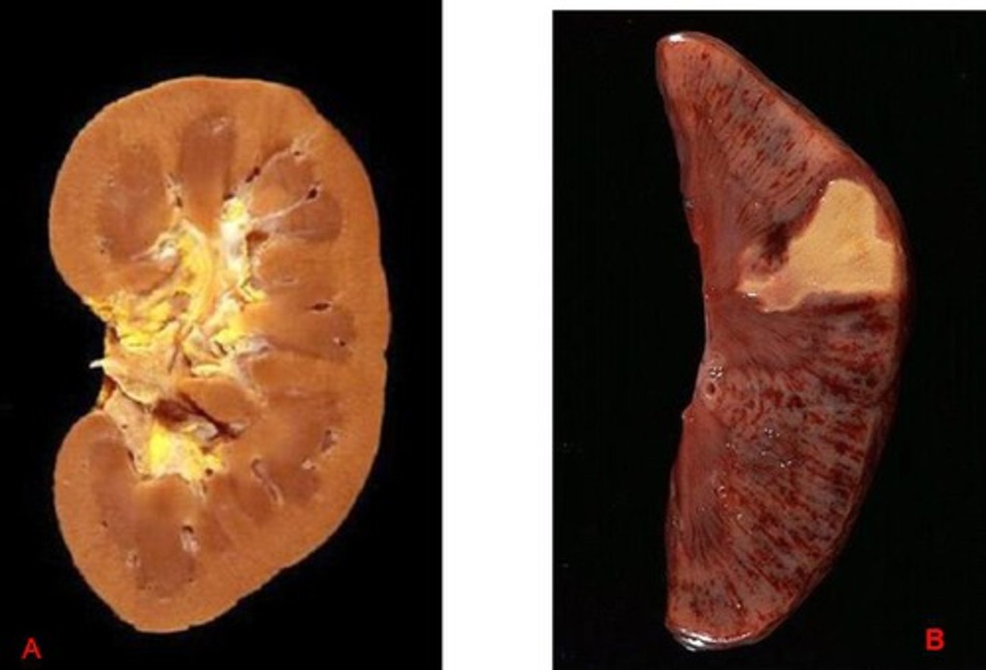 <p>- loss of nucleus with cellular outline preserved</p><p>- cellular degeneration is delayed - architecture is maintained (damaged but stays intact)</p><p>(kidney, heart, adrenal gland, dense organs)</p>