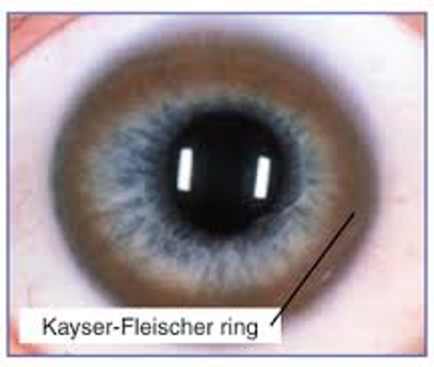 <p>Kayser-Fleischer rings in cornea</p>