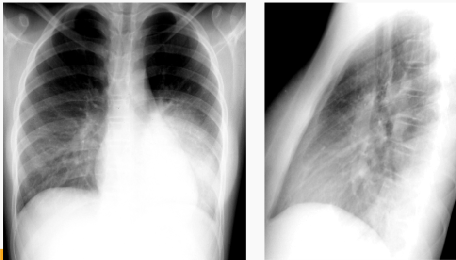 <p>What pattern of consolidation is this?</p>