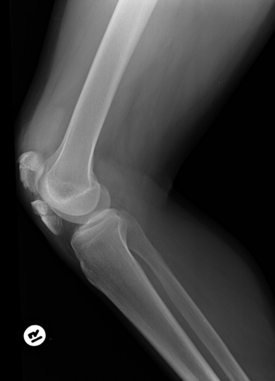 <p>Ignoring pathology and other factors - Is the tube angled appropriately in this image?</p><p></p>