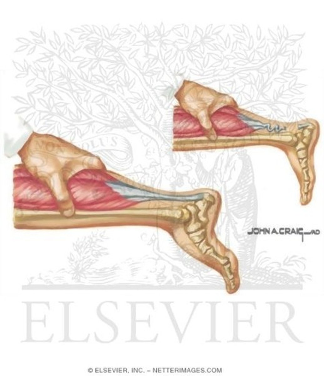 <p>Integrity of Achilles tendon</p>