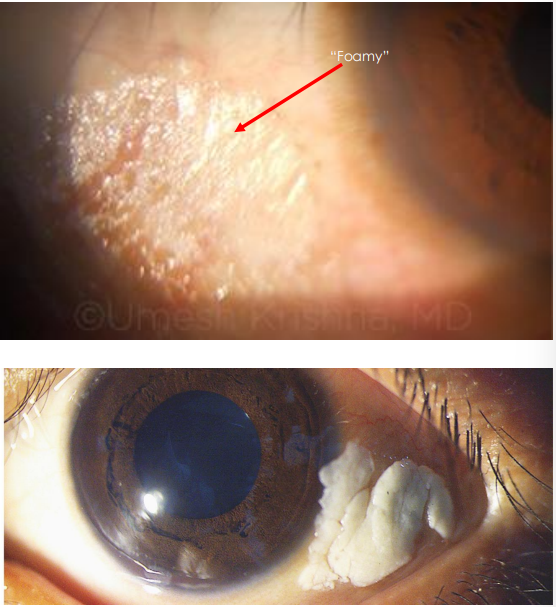<ol><li><p>• White-Grayish triangular patches of<strong><u> xerosed (dried) conjunctiva with foamy surface •</u></strong></p><ol><li><p> The tear film does not “wet” the surface •</p></li></ol></li><li><p> Location: Temporal conjunctiva, Often bilateral</p></li></ol><p></p>