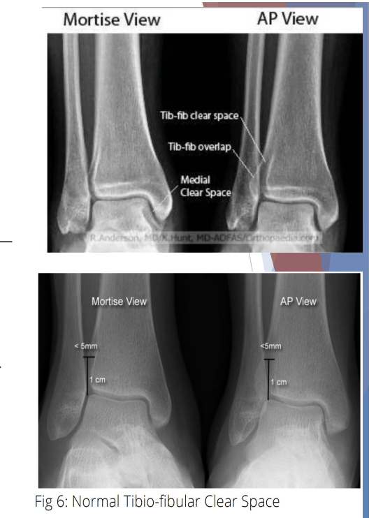 <p>Syndesmosis Sprain “High Ankle Sprain”</p>