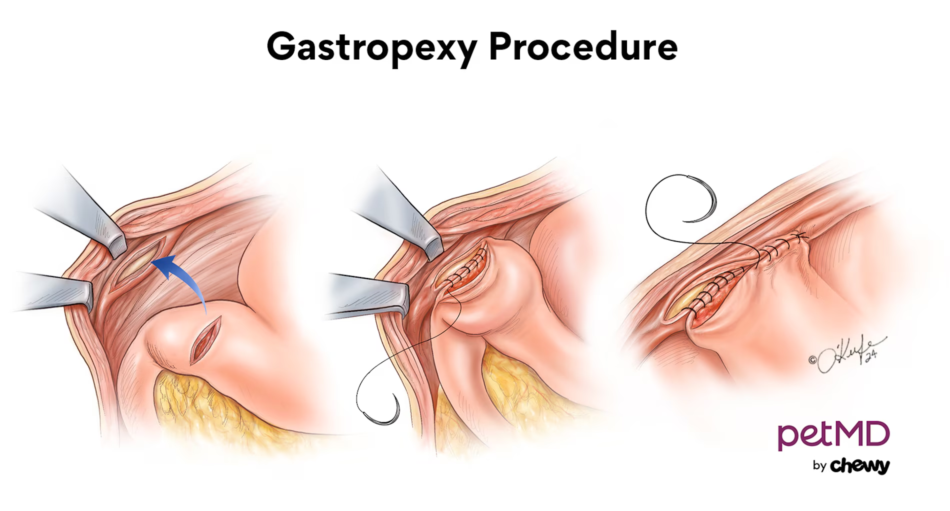 <p>Incision of pyloric antrum &amp; peritoneum w/ muscle -apposition- suture</p>