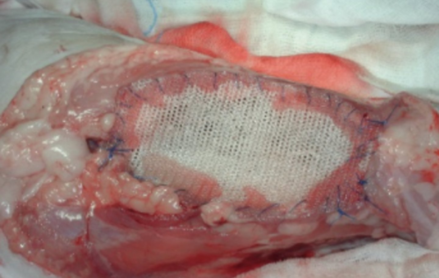 <p>mactectomía radical (eliminamos la fascia del músculo recto y la pared abdominal).</p><p>se puede requerir reconstrucción- colgajos musculares o malla polipropileno</p>