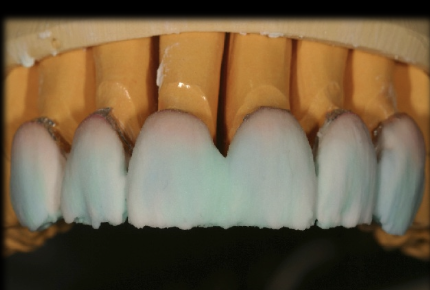 <p>Advantages of Feldspathic porcelain </p>