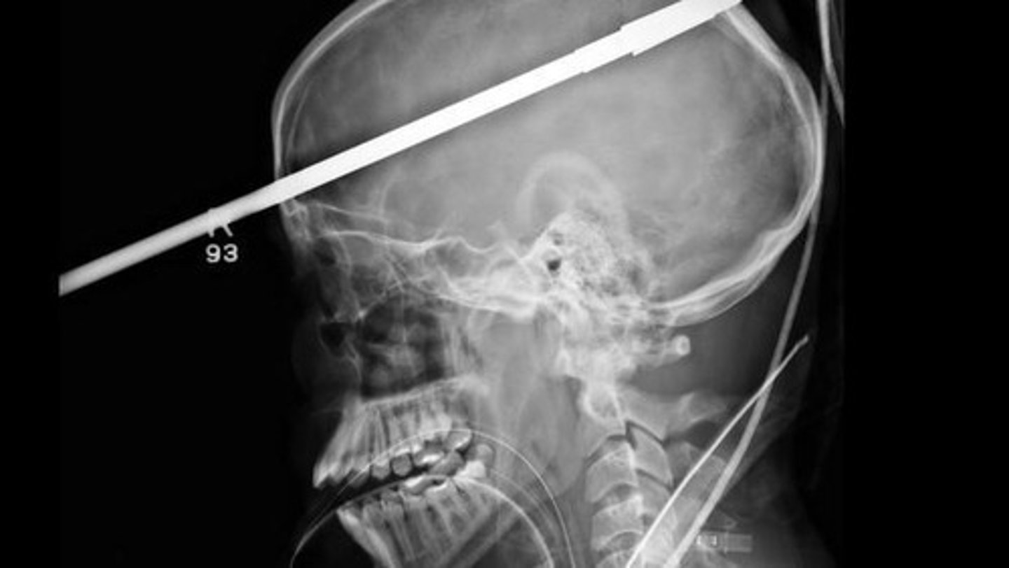 <p>An injury where brain tissue is damaged by an object that has pierced the skull.</p>
