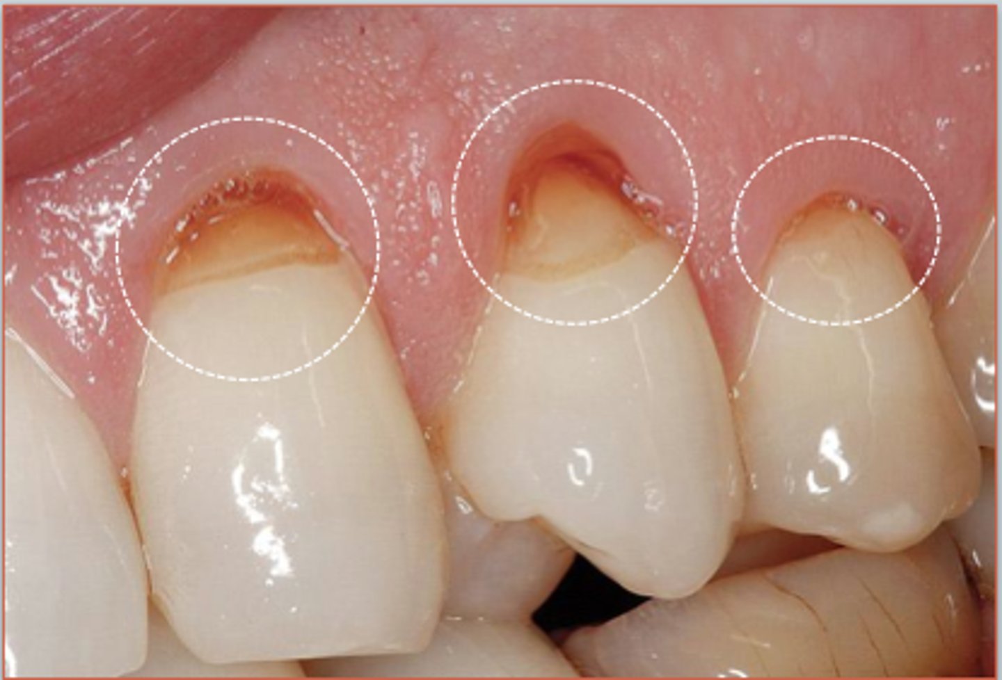<p>A picture of notched teeth , cause by pathological loss of tooth structure from tooth flexure during mastication. wedge shaped defects at the cervical area.</p>