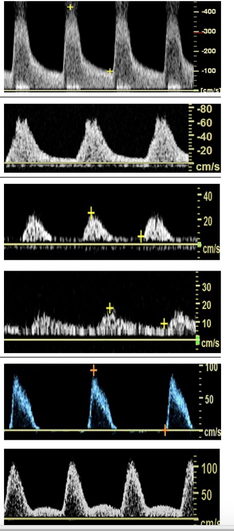 <p>Draw out these waveforms and state where they are in response to a stenosis, which is prox at and distal to a stenosis </p>