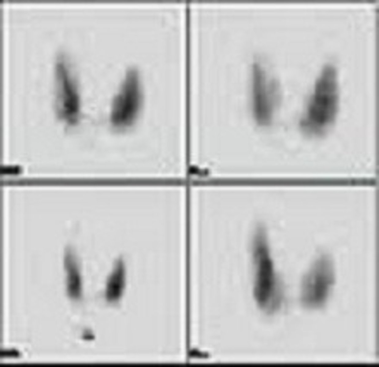 <p>-Radioactive iodine (iodine-123) is given orally</p><p>-Thyroid scanned to determine size and shape of glands</p><p>-Another test uses radioactive technetium IV to look for hyperfunctioning thyroid nodules accumulating more radioactivity (hot spots) and were there is no concentration (cold spots, thyroid cancer)</p>