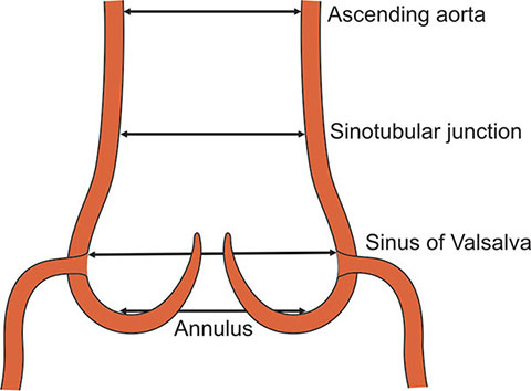 <p>How do Semilunar valves prevent backflow into the ventricles?</p>