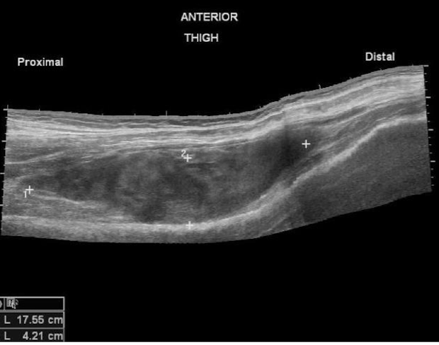 <p><strong>abnormal collection of blood outside blood vessel </strong><br><em>risk factors: </em>anticoagulation, bleeding disorders</p><p>-impairs wound healing <strong>↑ tension and ↓ tissue perfusion</strong><br>-may cause <strong>deep space infection</strong><br><strong>-</strong>may <strong>compress structures cause nerve damage</strong></p><p>Tx: <strong>evacuate</strong> <strong>expanding hematomas surgically </strong>to regain hemostasis, drains, closed suction drainage</p>