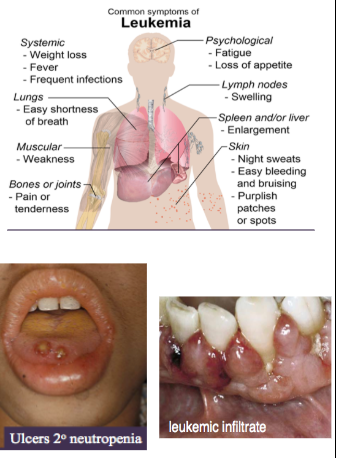 <p><span style="background-color: transparent; font-family: "Times New Roman", serif;">*Due to reduction of rbcs and wbcs caused by crowding out of normal marrow cells by malignant leukemic cells → <strong>myelophthisic anemia</strong></span><br></p><p><span style="background-color: transparent; font-family: "Times New Roman", serif;"><u>SYSTEMIC</u>:</span></p><p><span style="background-color: transparent; font-family: "Times New Roman", serif;">*Anemia → fatigue</span></p><p><span style="background-color: transparent; font-family: "Times New Roman", serif;">*Neutropenia → ulcerations, bacterial, fungal, viral infections</span></p><p><span style="background-color: transparent; font-family: "Times New Roman", serif;">*Thrombocytopenia → bleeding, bruising</span><br></p><p><span style="background-color: transparent; font-family: "Times New Roman", serif;"><u>ORAL</u>:</span></p><p><span style="background-color: transparent; font-family: "Times New Roman", serif;"><strong>*Mucosal pallor</strong></span></p><p><span style="background-color: transparent; font-family: "Times New Roman", serif;"><strong>*Mucosal petechiae, purpura</strong></span></p><p><span style="background-color: transparent; font-family: "Times New Roman", serif;"><strong>*Ulcerations</strong></span></p><p><span style="background-color: transparent; font-family: "Times New Roman", serif;"><strong>*Fungal infections (eg candidiasis)</strong></span></p><p><span style="background-color: transparent; font-family: "Times New Roman", serif;"><strong>*Viral Infections (eg herpetic lesions)</strong></span></p><p><span style="background-color: transparent; font-family: "Times New Roman", serif;"><strong>*Gingival Leukemic Infiltrate = tumor-like collection of leukemic cells (granulocytic sarcoma or extramedullary myeloid leukemia, old term = chloroma), usually <u>myeloid, type, </u>spontaneous bleeding (no spontaneous bleeding in benign hyperplasia)</strong></span></p>
